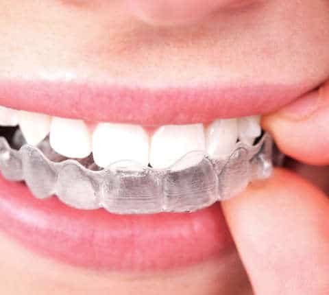 Why Are Invisible Braces Are So Popular?